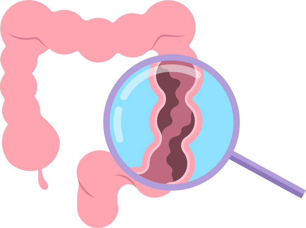 surgery treat stoma belly Hernia bowel tumor  stomach ileostomy bag ulcerative syndrome crohn's Irritable polyp proctocolectomy colitis  prolapse large colonic inertia Examination